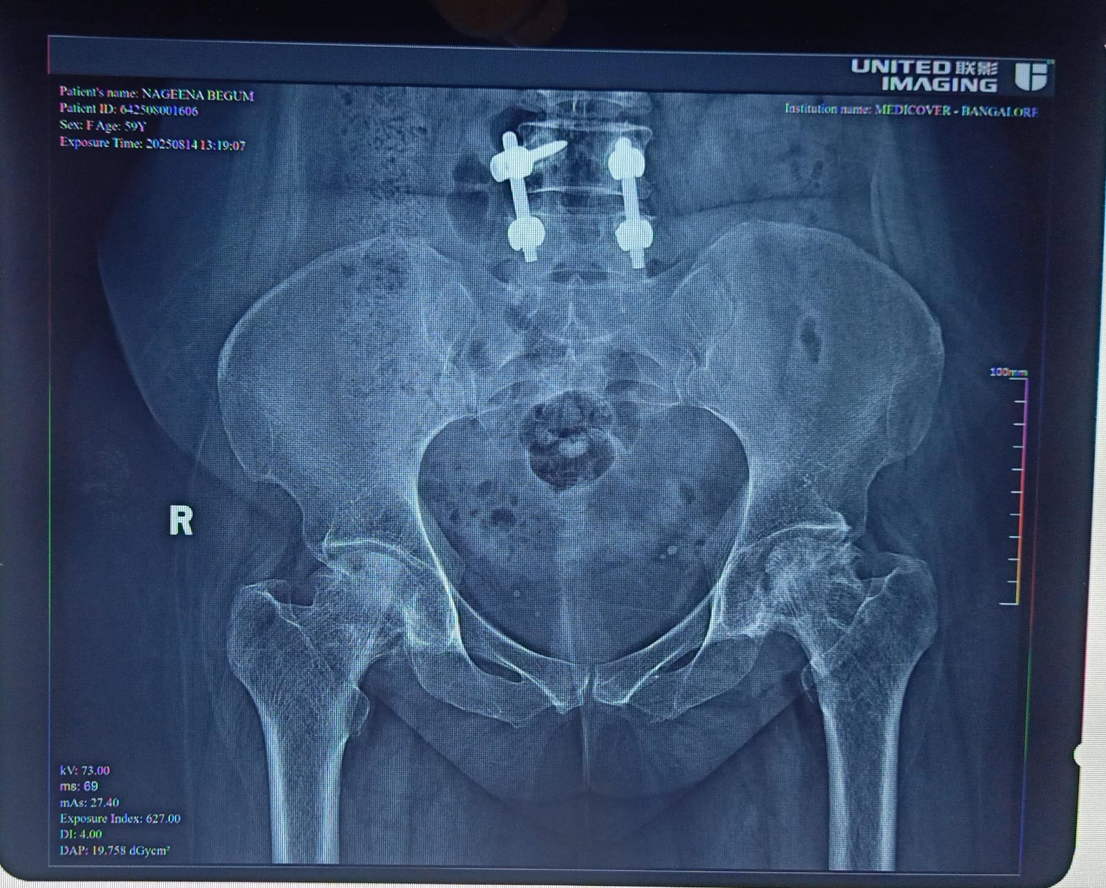 Before hip fracture fixation X-ray